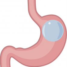 ballongastrique