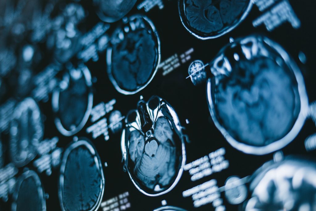 MRI scan of the brain