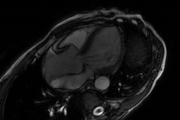 IRM cardiaque