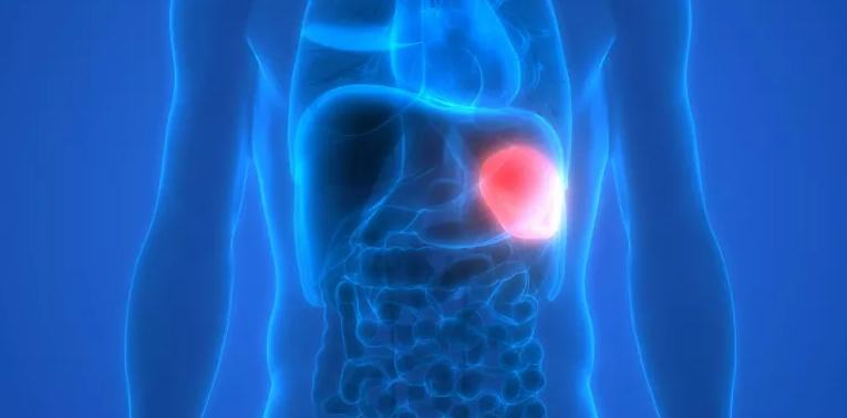 ablation de la rate – splénectomie