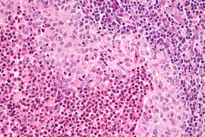 histiocytoses-hereditaires-sporadiques